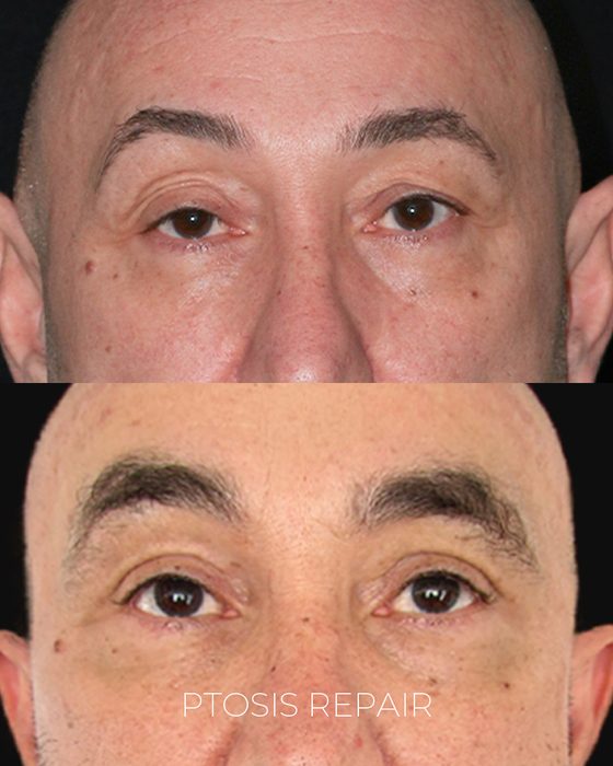 Ptosis Repair before and after