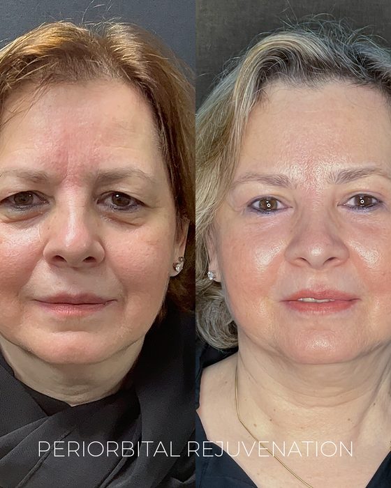 Periorbital Rejuvenation before and after