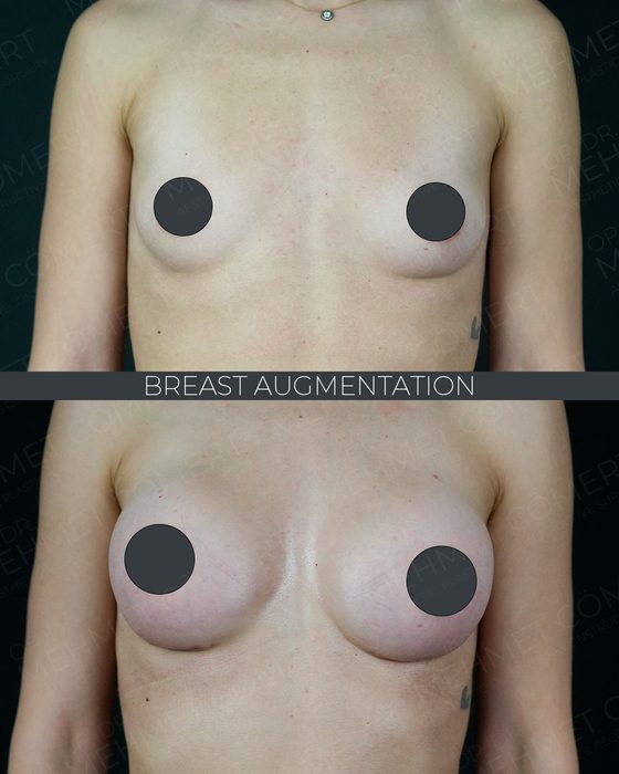 Breast Augmentation before and after