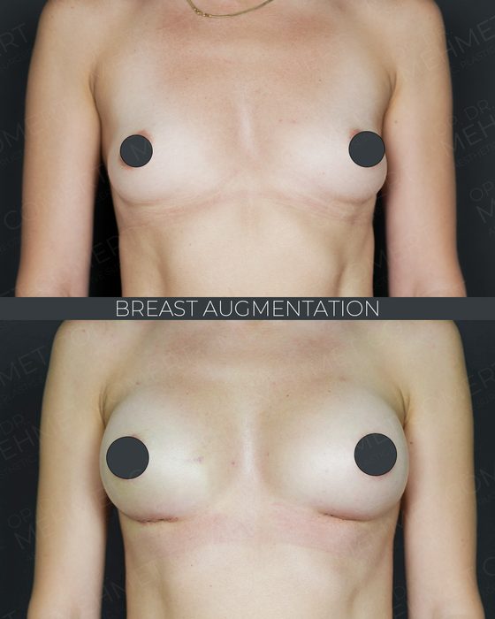 Breast Augmentation before and after