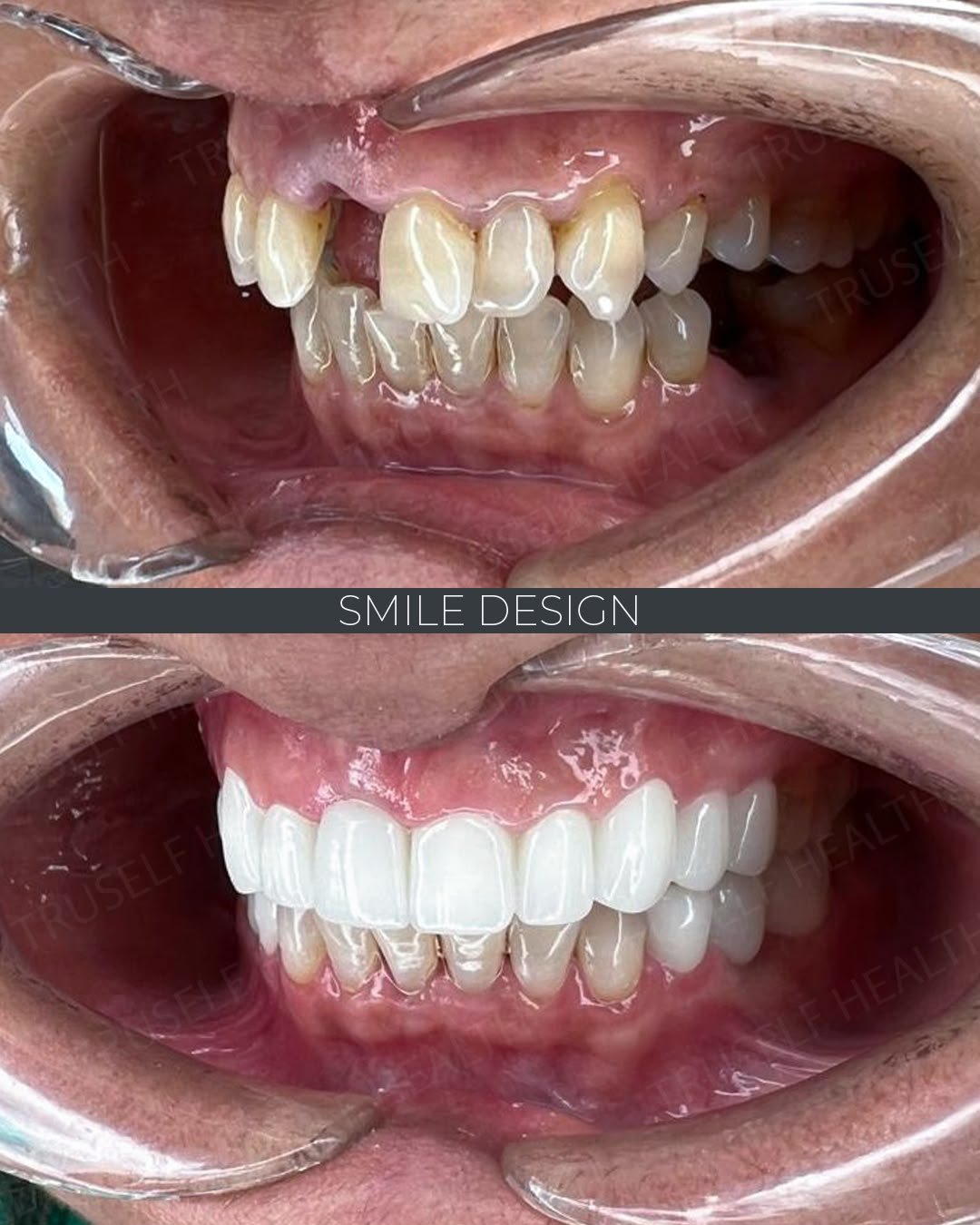 Hollywood Smile before and after — smile design with porcelain veneers at Truself Health Group