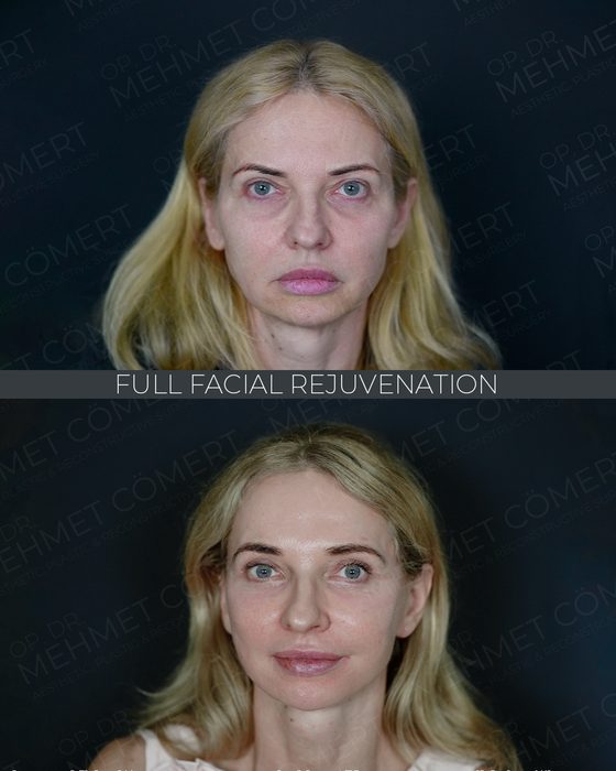 Full Facial Rejuvenation before and after