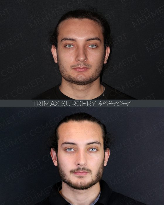 Trimax Surgery before and after