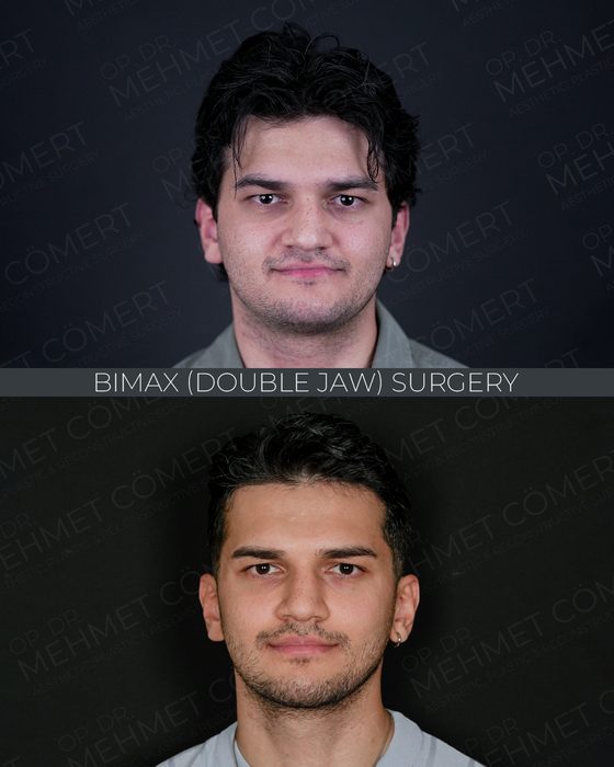 Bimax (Double Jaw) Surgery before and after