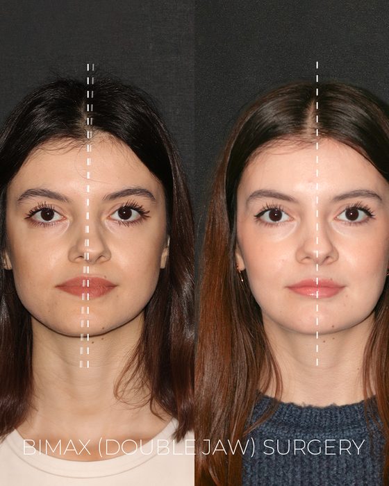 Bimax (Double Jaw) Surgery before and after