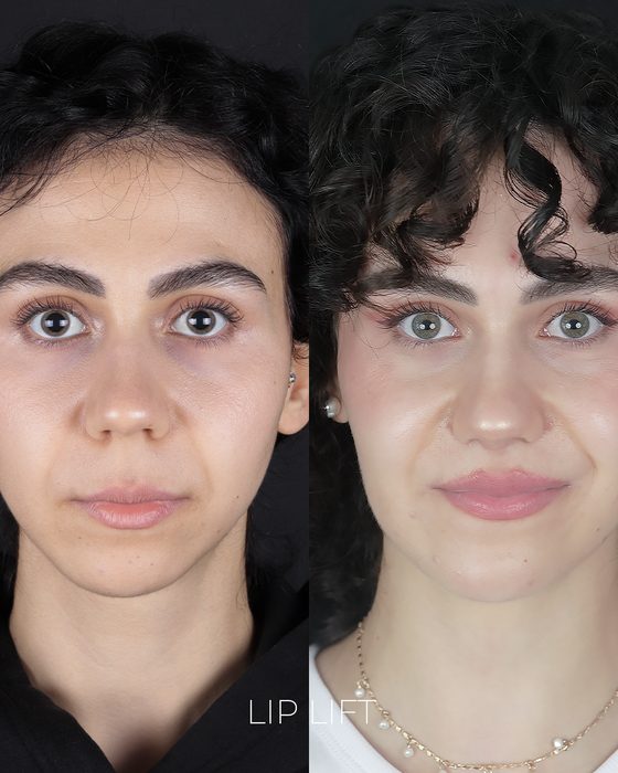 Lip Lift before and after