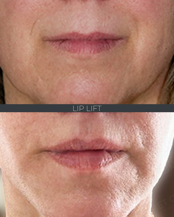 Lip Lift before and after