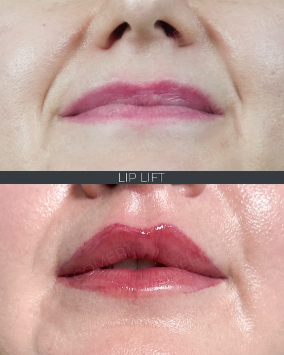 Lip Lift before and after