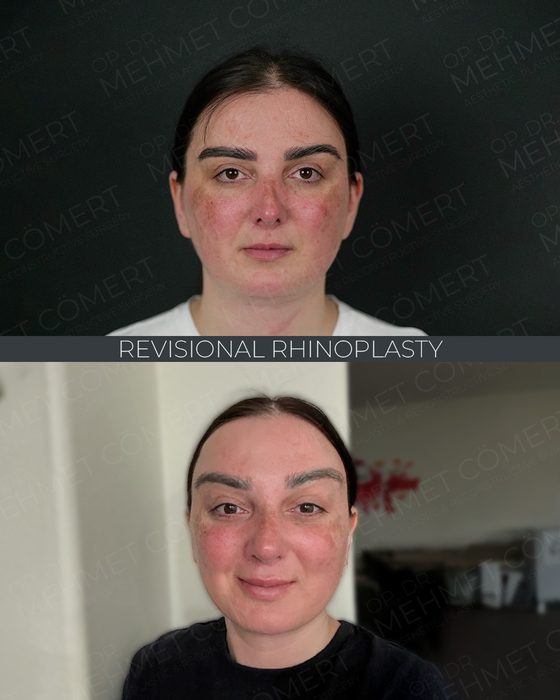 Revisional Rhinoplasty before and after