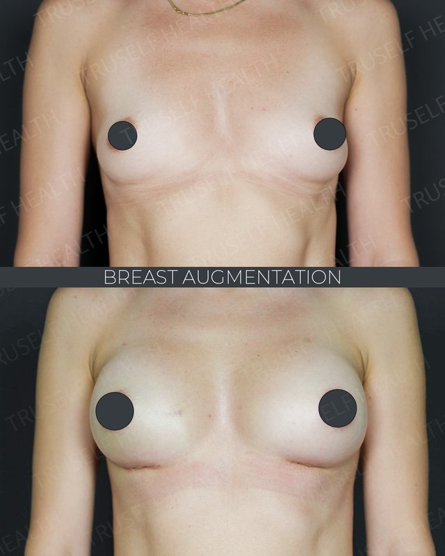 Breast augmentation result