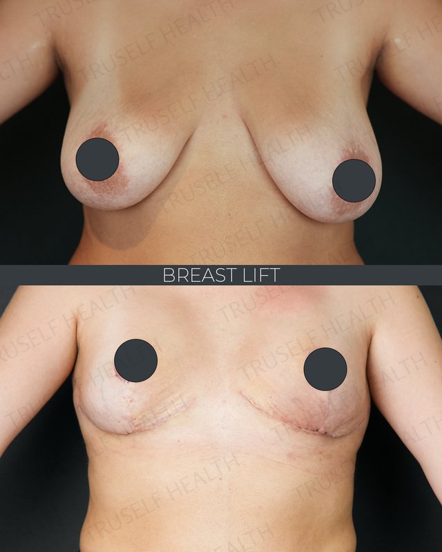 Breast lift result