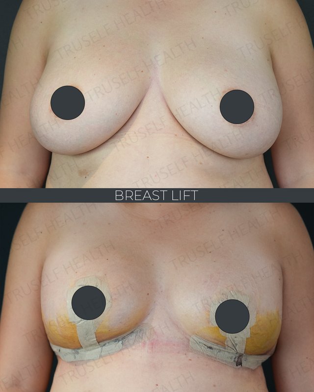 Breast lift result