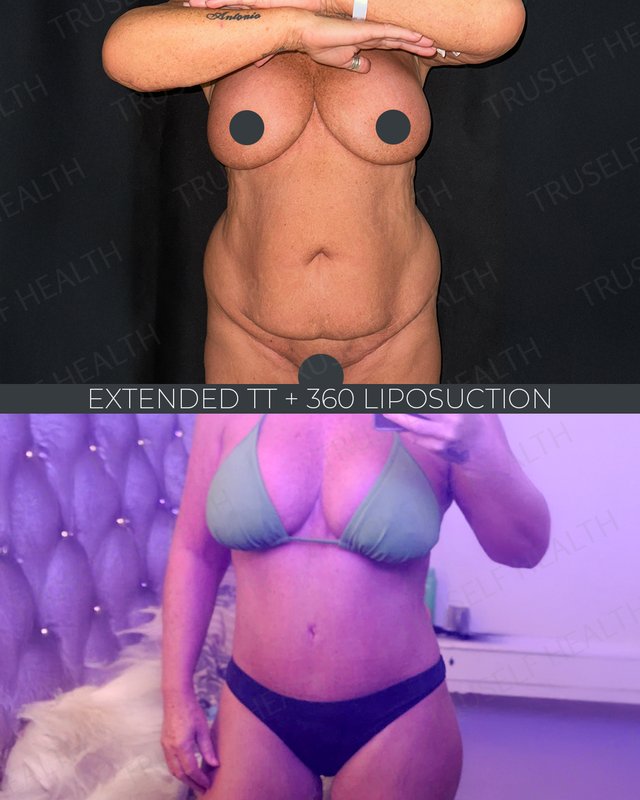 Tummy tuck and liposuction result