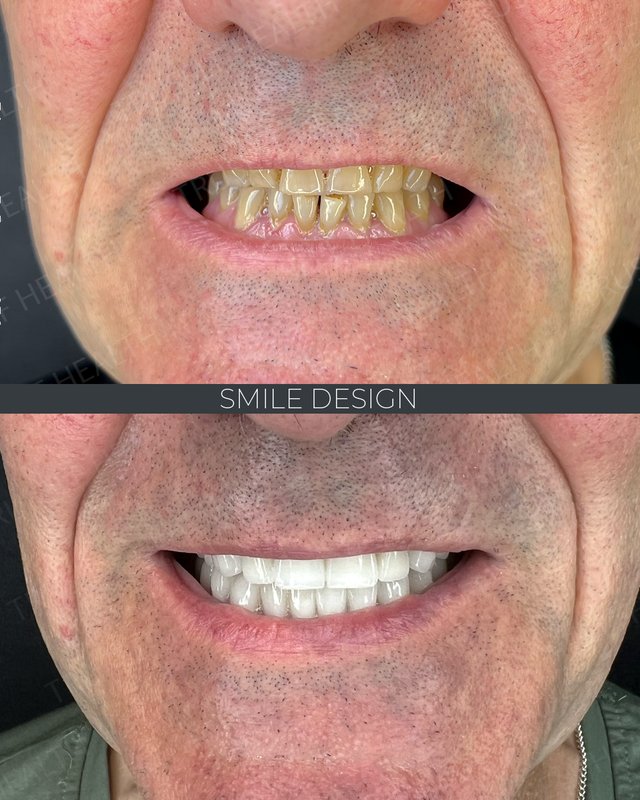 Smile design result