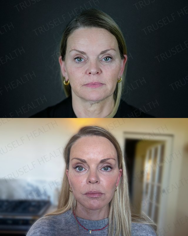 Deep plane facelift result