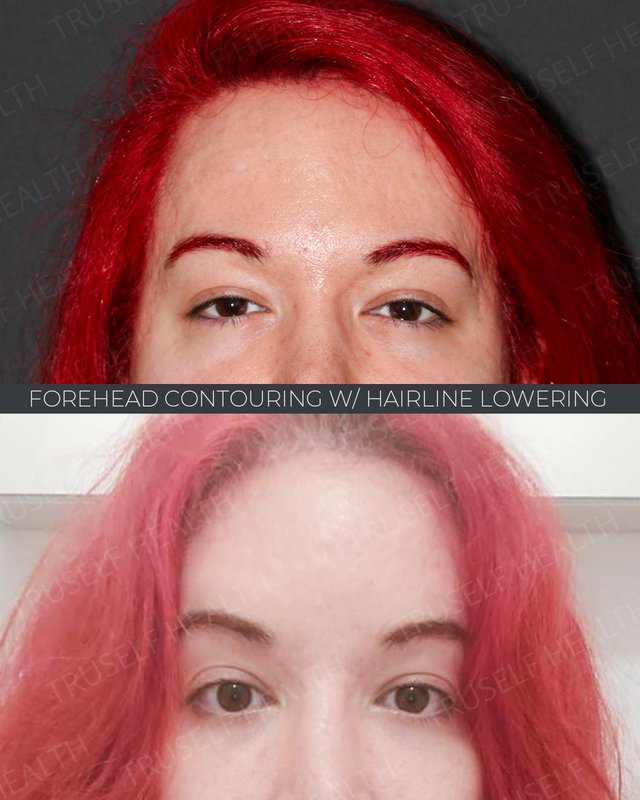 Forehead and hairline lowering result