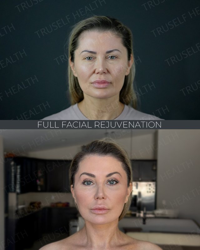 Full facial rejuvenation result