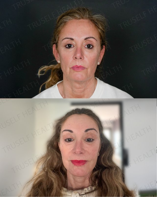 Full facial rejuvenation result