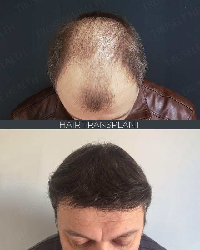 Hair transplant result