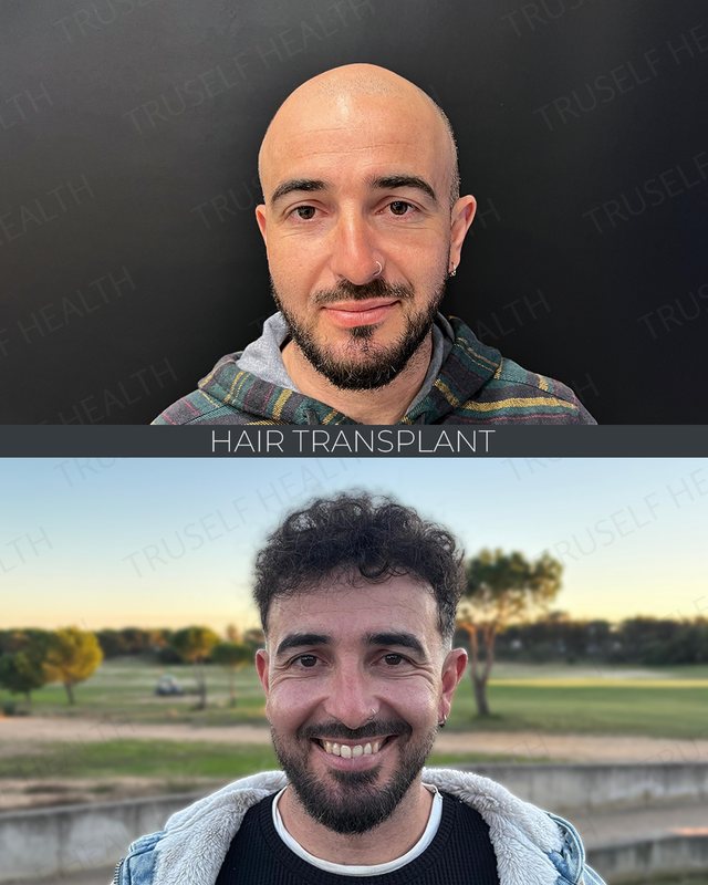 Hair transplant result