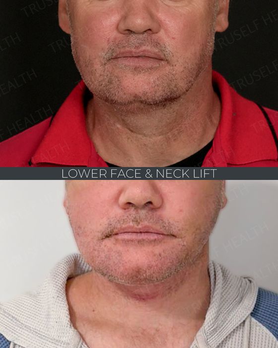 Jaw & Chin Surgery before and after