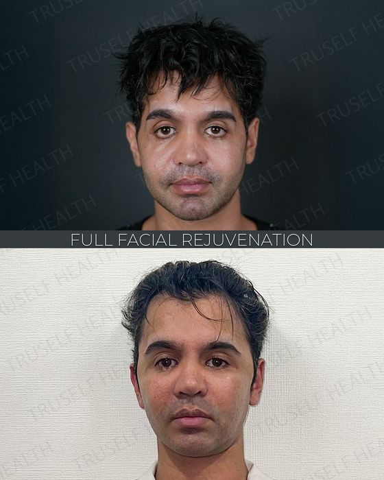 Facial Rejuvenation before and after