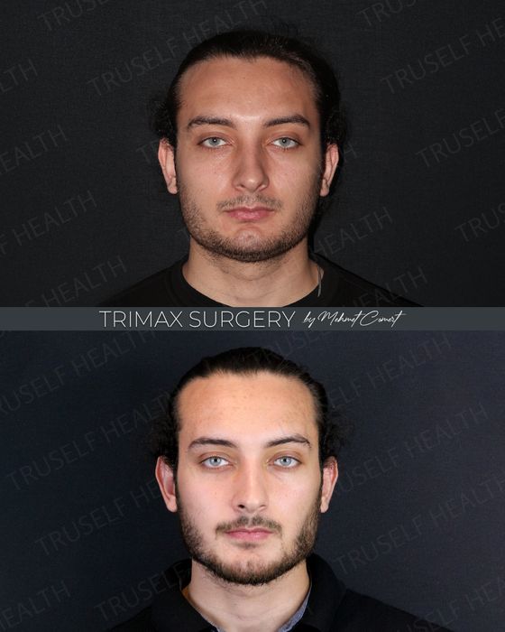 Jaw & Chin Surgery before and after