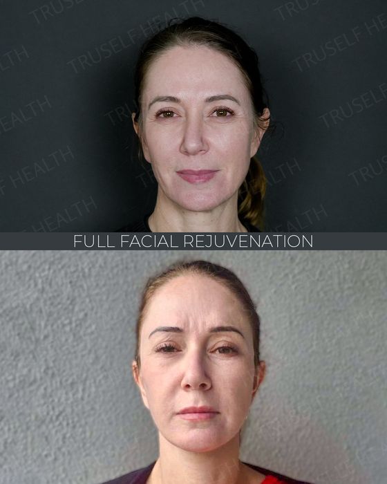Facial Rejuvenation before and after