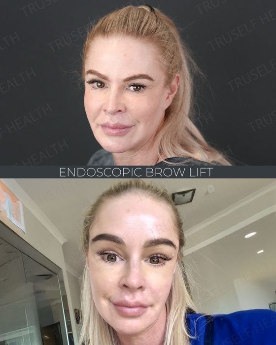 Eyelid & Brow before and after