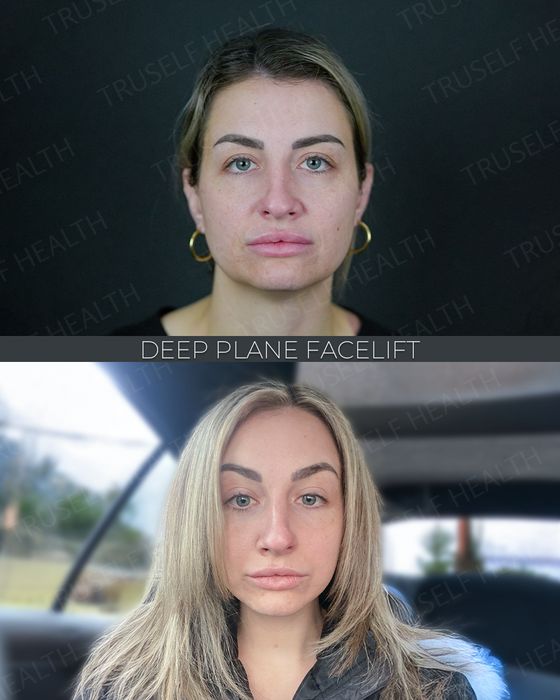 Facial Rejuvenation before and after