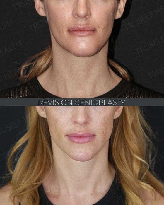 Jaw & Chin Surgery before and after
