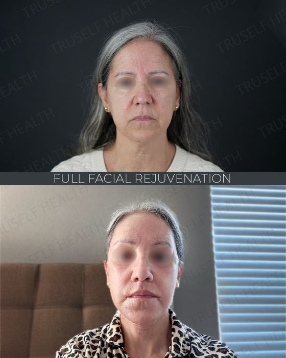 Facial Rejuvenation before and after