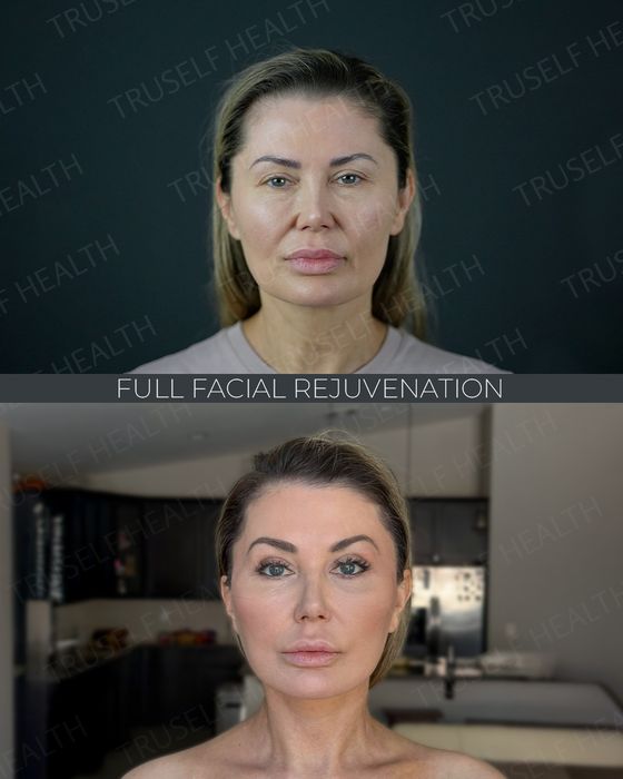Facial Rejuvenation before and after