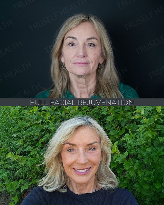 Facial Rejuvenation before and after