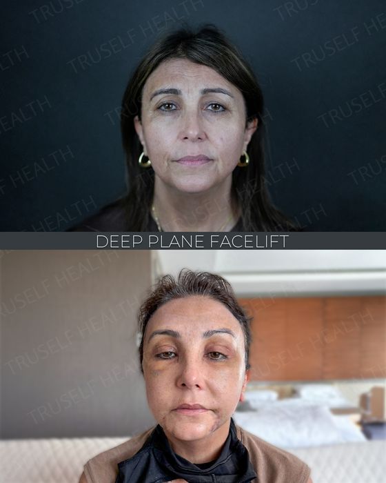 Facial Rejuvenation before and after