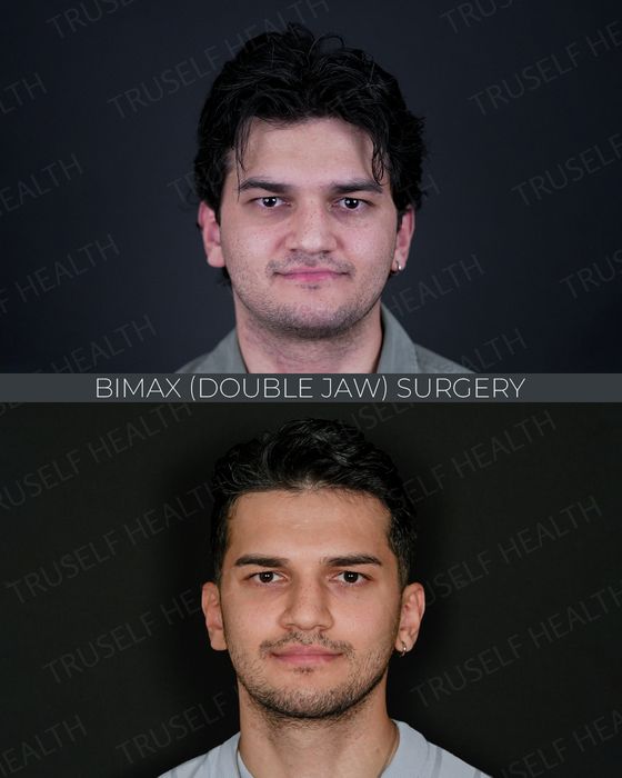 Facial Rejuvenation before and after