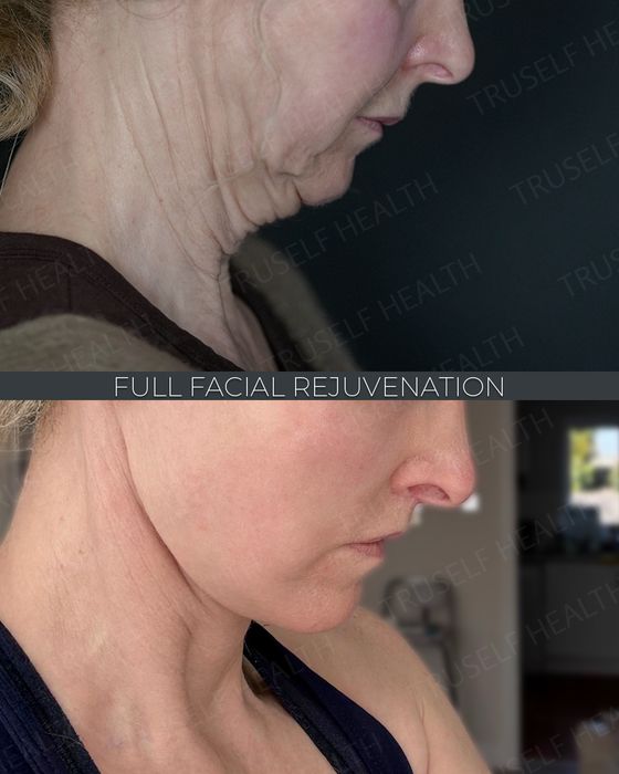Facial Rejuvenation before and after