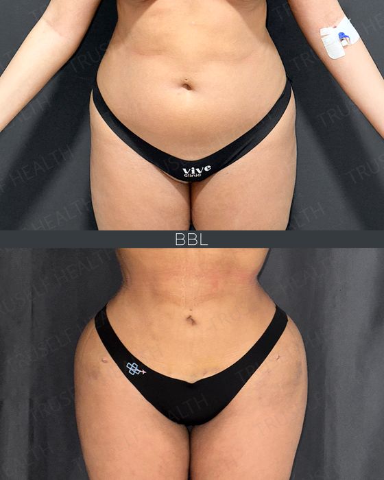 Body Contouring before and after