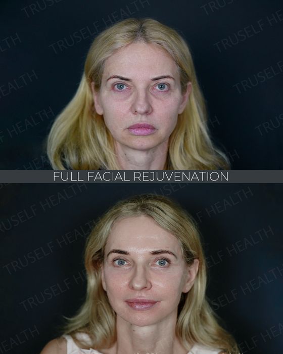 Facial Rejuvenation before and after