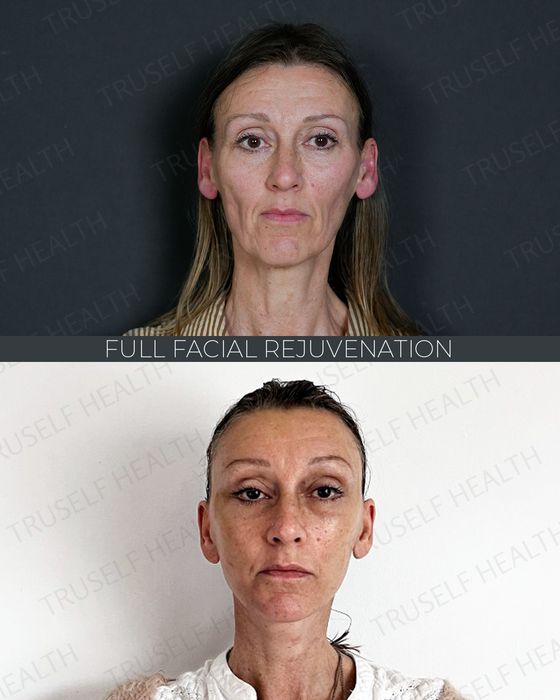 Facial Rejuvenation before and after