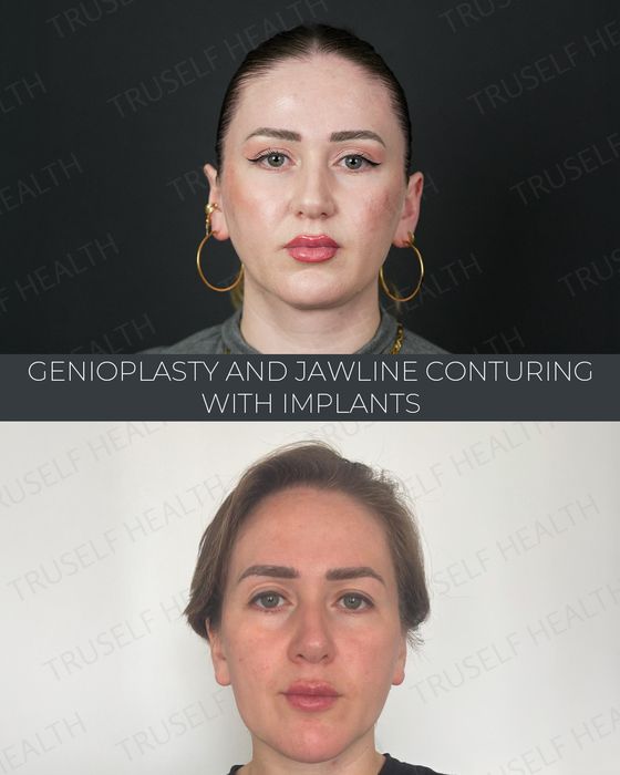 Facial Rejuvenation before and after