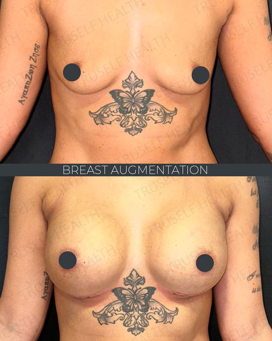 Breast Surgery before and after