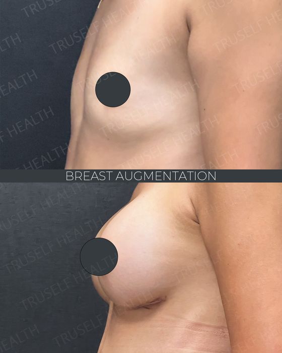Breast Surgery before and after