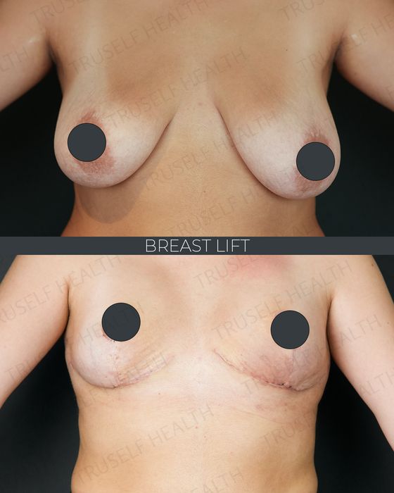 Breast Surgery before and after