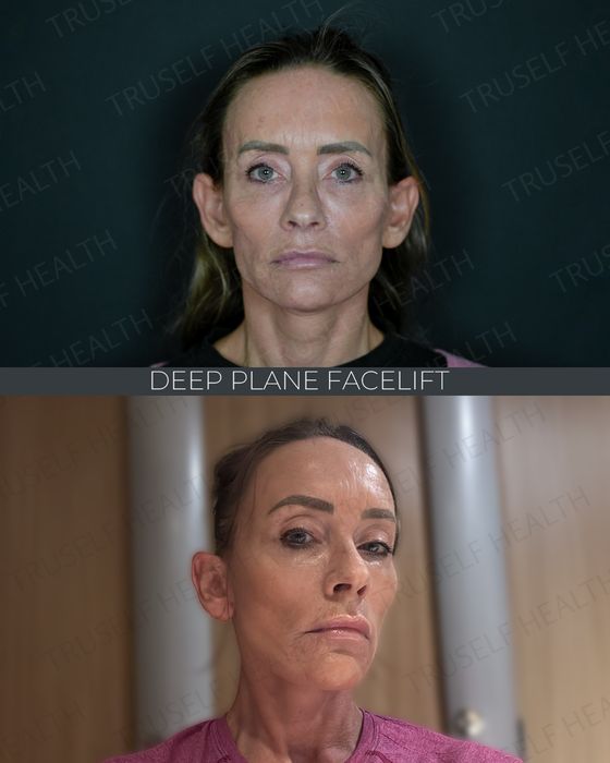 Facial Rejuvenation before and after
