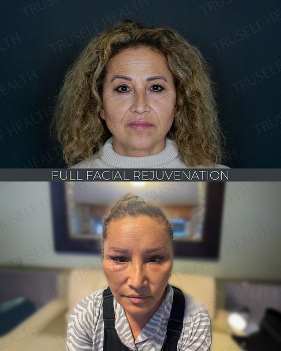 Facial Rejuvenation before and after