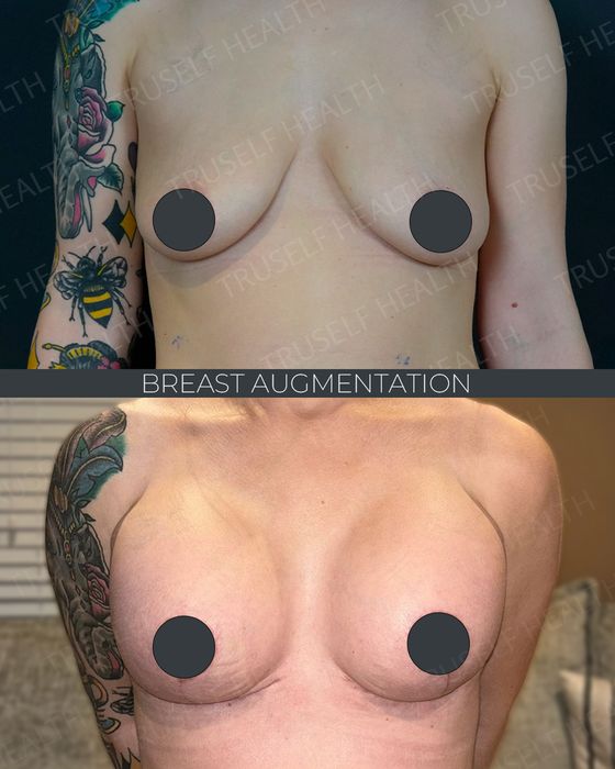 Breast Surgery before and after