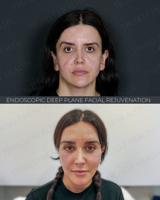 Facial Rejuvenation before and after