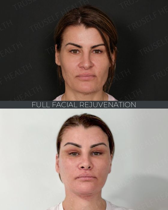 Facial Rejuvenation before and after