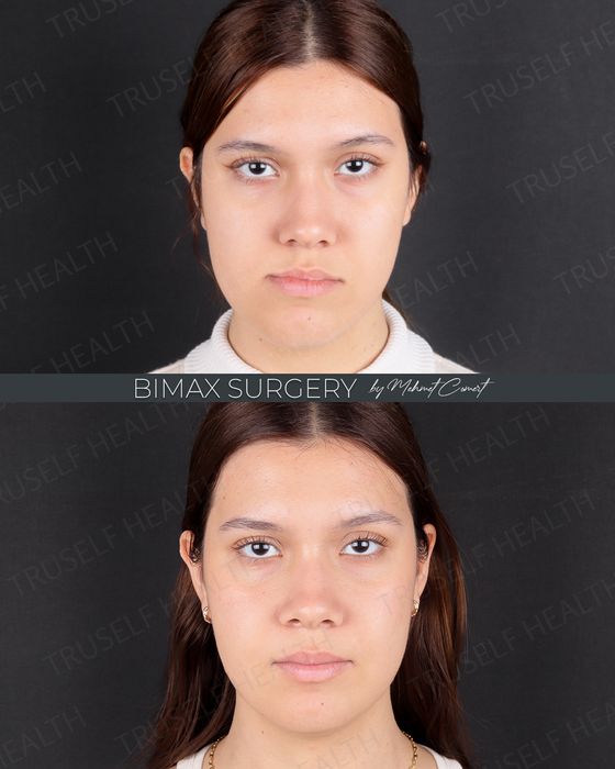 Jaw & Chin Surgery before and after
